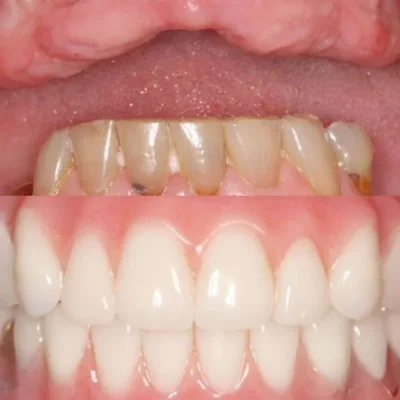 OralFit heat-mouldable removable veneers