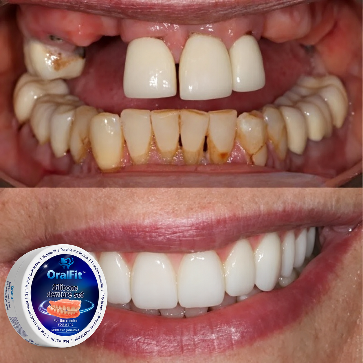 OralFit dental-grade thermoplastic veneers