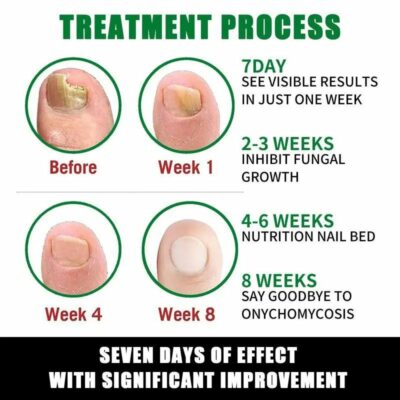 Umex leave-on serum for fingernails and toenails