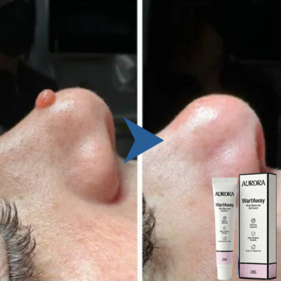Aurora Health WartAway™ Wart Cream