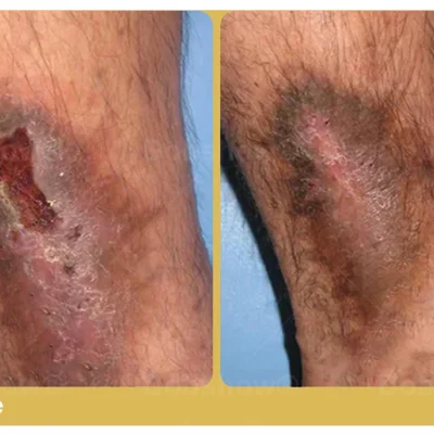 Healrize®GlucoShield spray with Sophora flavescens