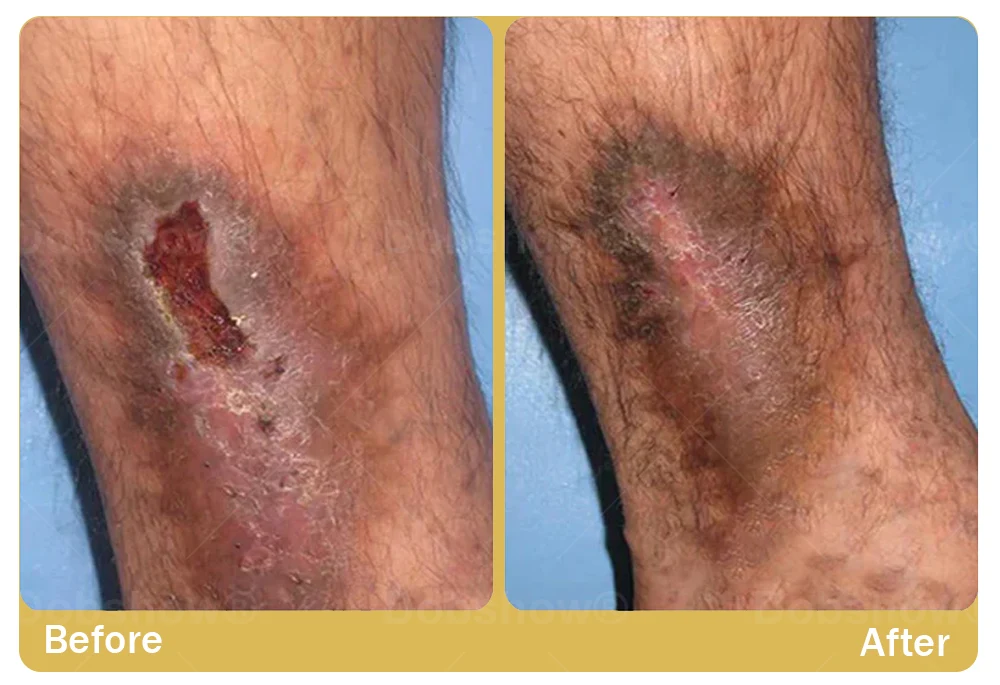 Healrize®GlucoShield spray with Sophora flavescens