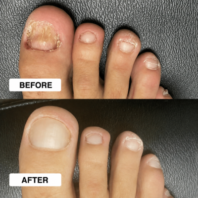 NailEase™ topical spray for fungal nail concerns