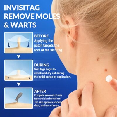 InvisiTag natural ingredient patch for skin tags and warts