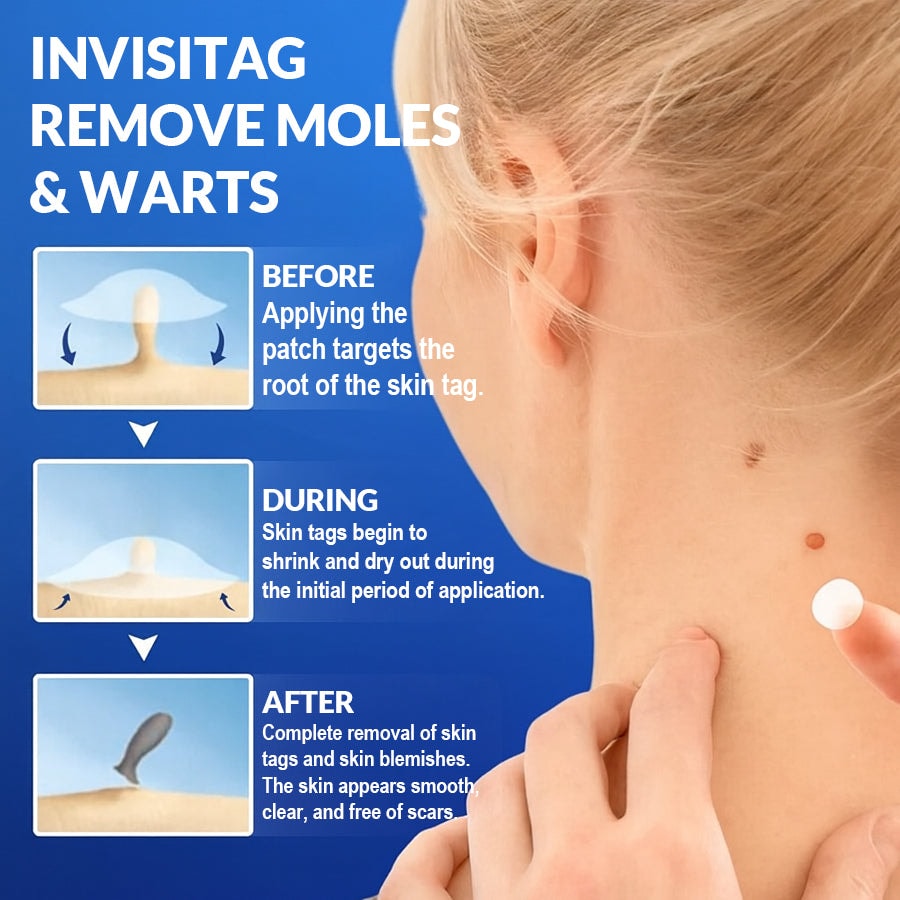 InvisiTag natural ingredient patch for skin tags and warts