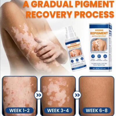 KUBOZN® non-steroid spray for targeted white patch skin care