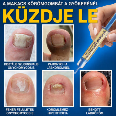 Trilumia FungiFree méhméreg formulával körömápoláshoz