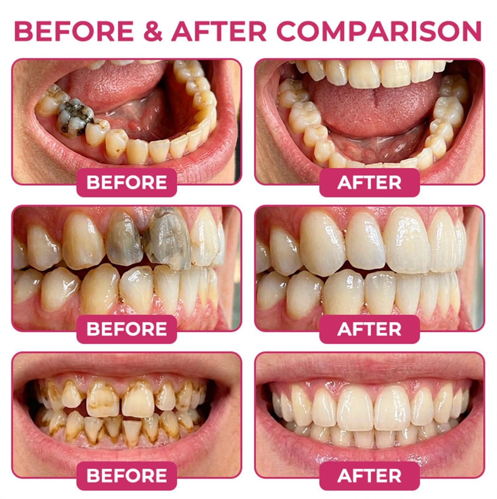 COUGEX oral gel containing 10% nano-hydroxyapatite